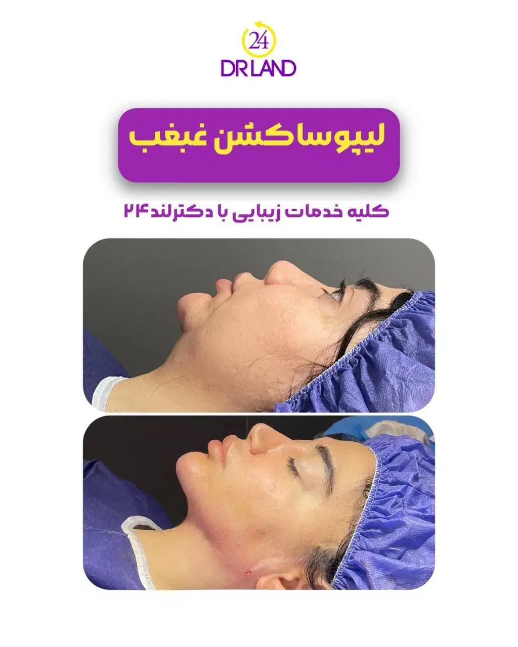 لیپو شکم،ابدو،غبغب،ماموپلاستی،فیلر بادی پروتزسینه|خدمات آرایشگری و زیبایی|شیراز, معالی‌آباد|دیوار