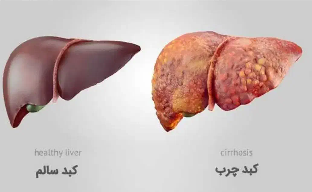 کمک به بهبود کبد چرب|آرایشی، بهداشتی، درمانی|کلاله, |دیوار