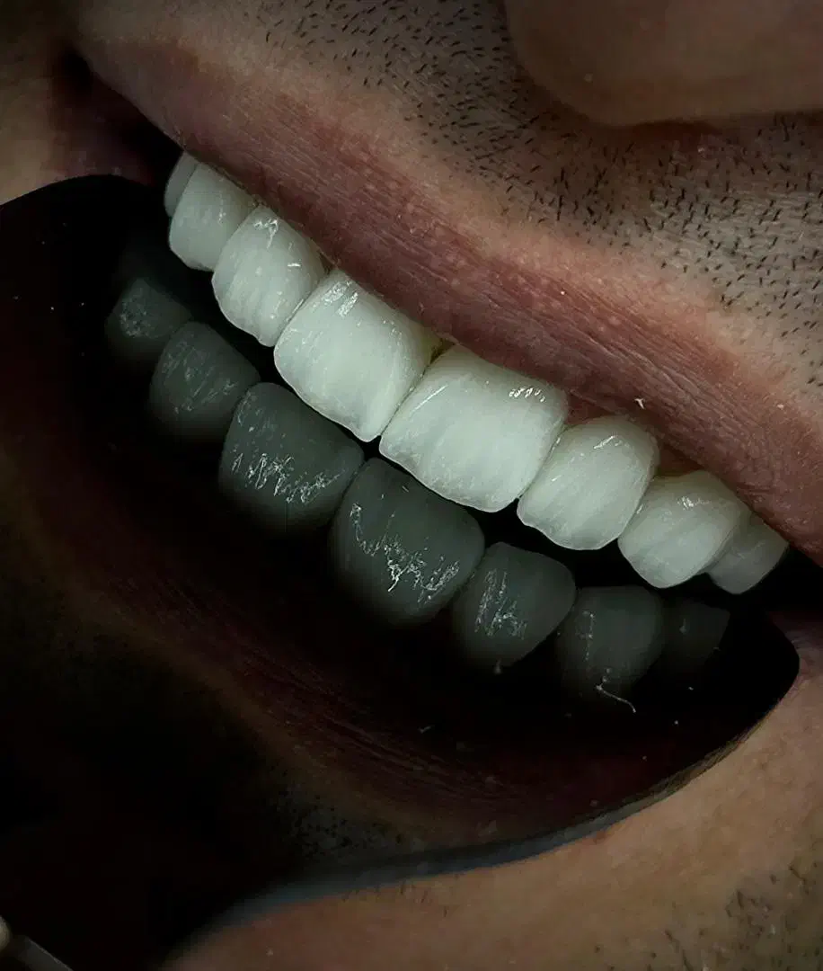 کامپوزیت،لمینیت اقساط 2 تا 12 ماهه|خدمات آرایشگری و زیبایی|بومهن, |دیوار