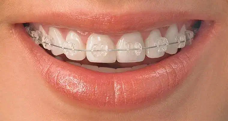 ارتودنسی تخصصی اقساطی|خدمات آرایشگری و زیبایی|نقده, |دیوار
