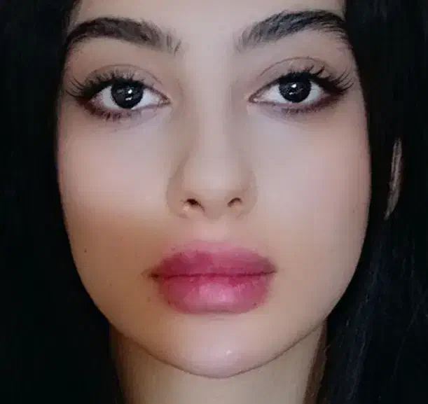 تزریق ژل و بوتاکس|خدمات آرایشگری و زیبایی|تفرش, |دیوار