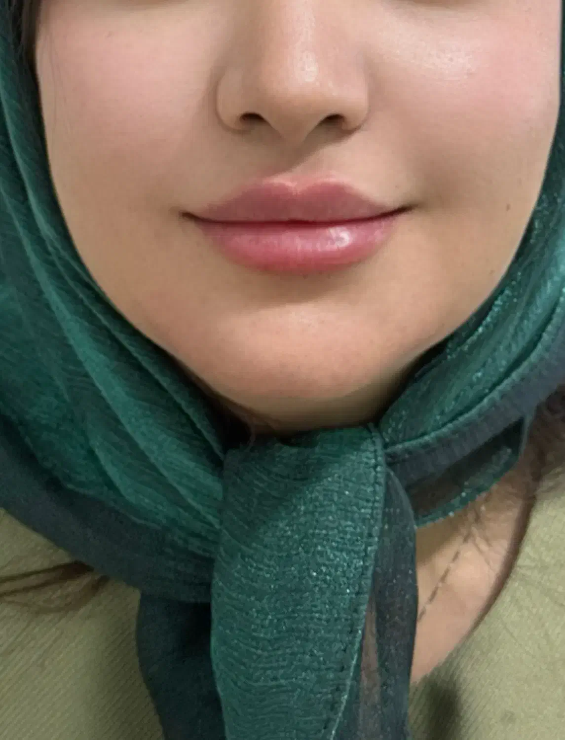 آموزش فیلر و بوتاکس|خدمات آموزشی|کرمان, |دیوار