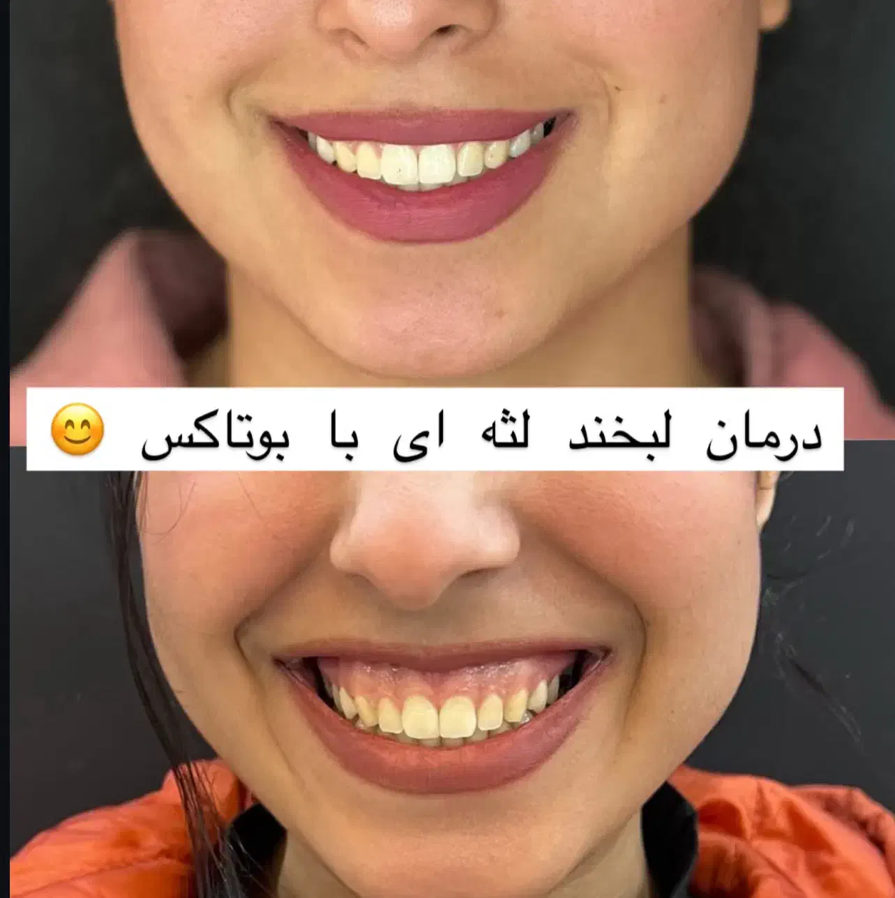 بوتاکس مصپورت۵۹۹ژل مجوزدار ۱/۲۰۰مادلینگ۵/۹۹۹|خدمات آرایشگری و زیبایی|قم, حاج زینل|دیوار