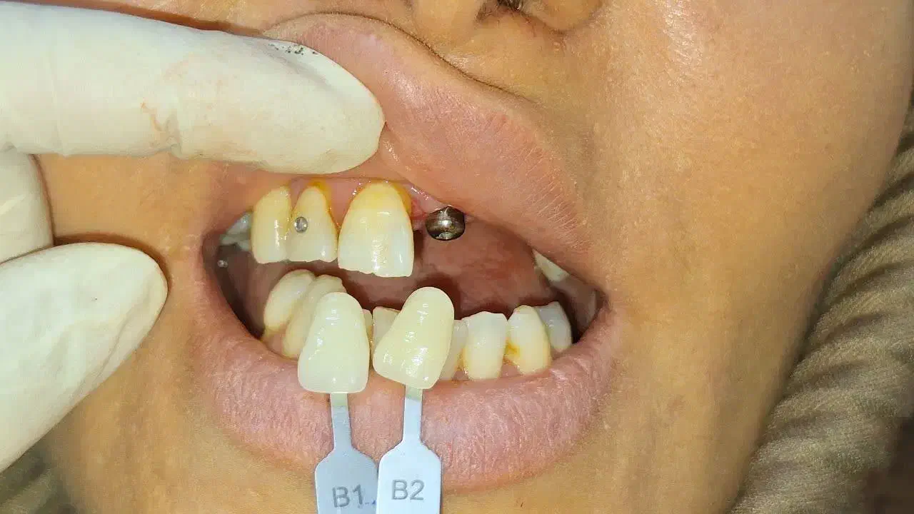 دستیار دندانپزشک|استخدام درمانی، زیبایی، بهداشتی|قم, نیروگاه|دیوار