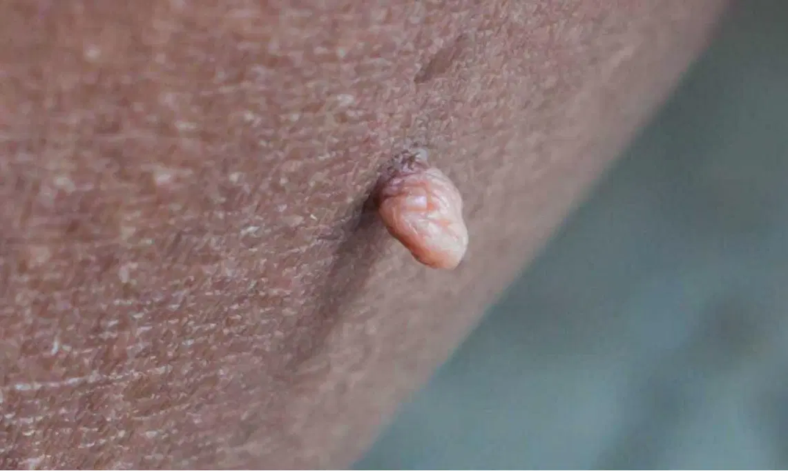 زگیلhpv|آرایشی، بهداشتی، درمانی|شیراز, پودنک|دیوار