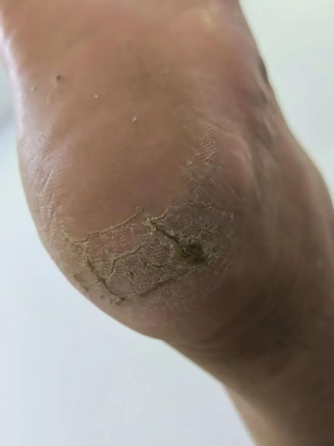 دوست داری ترک پاهات درمان بشه با یه قیمت منصفانه|خدمات آرایشگری و زیبایی|بندر انزلی, نوروزی|دیوار