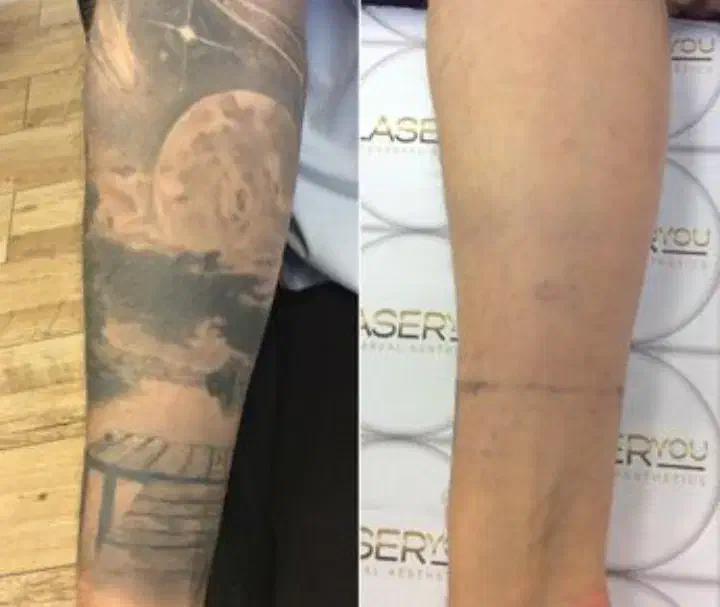 پاک کردن تتو.لیزرکیوسوییچ.PRP.کربن تراپی.روشن سازی|خدمات آرایشگری و زیبایی|اصفهان, سعادتآباد|دیوار