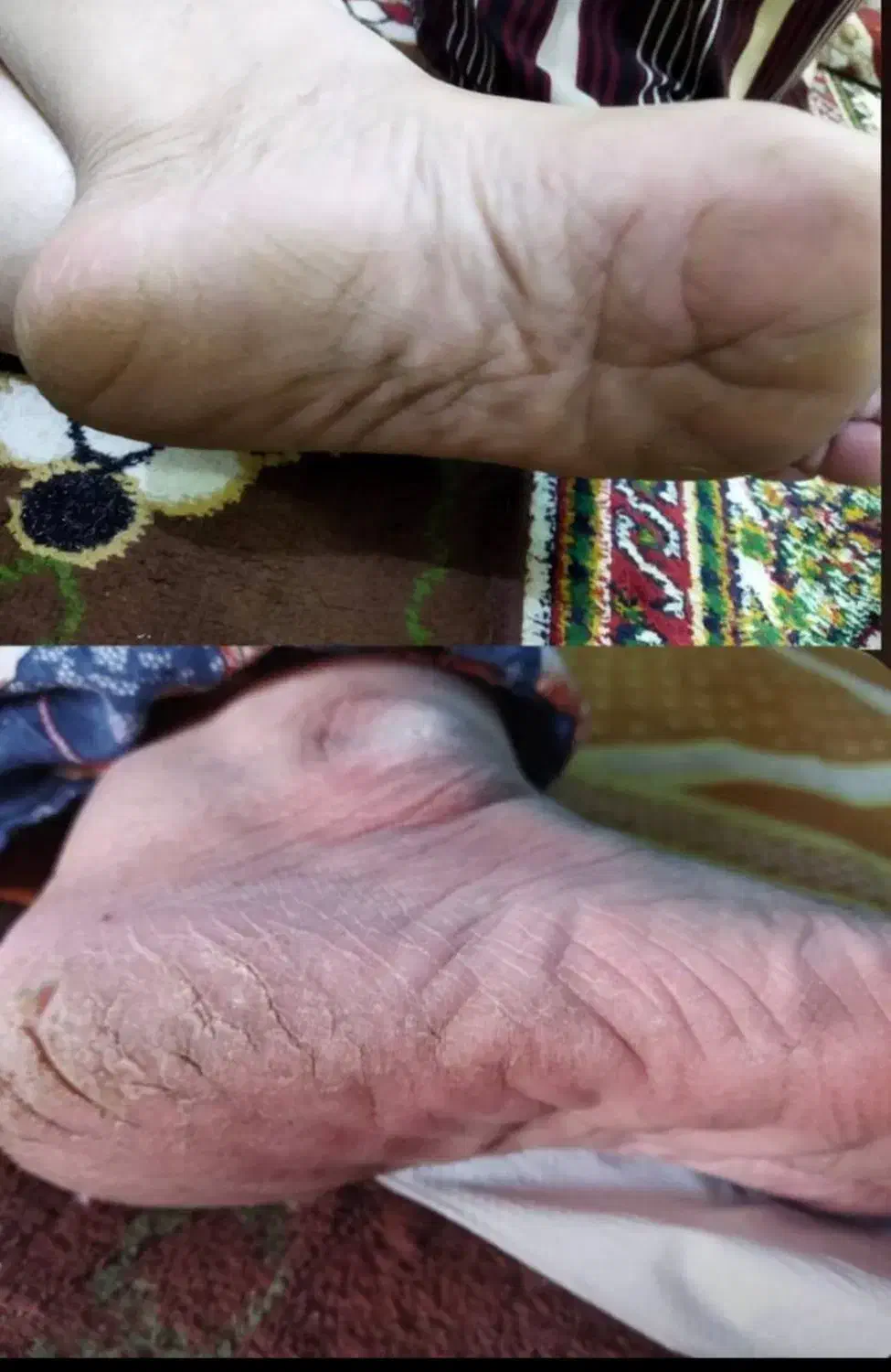 درمان ترک پا|آرایشی، بهداشتی، درمانی|شادگان, |دیوار