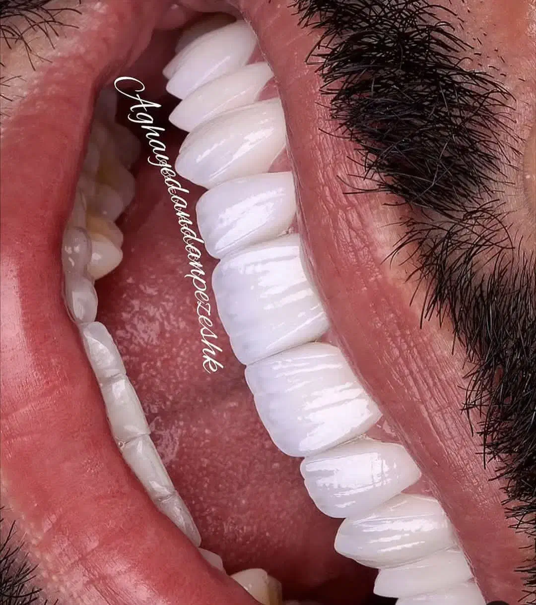 جشنواره دندان ونیر کامپوزیت روکش لمینیت عصب  IMAX|خدمات آرایشگری و زیبایی|تهران, هفت حوض|دیوار