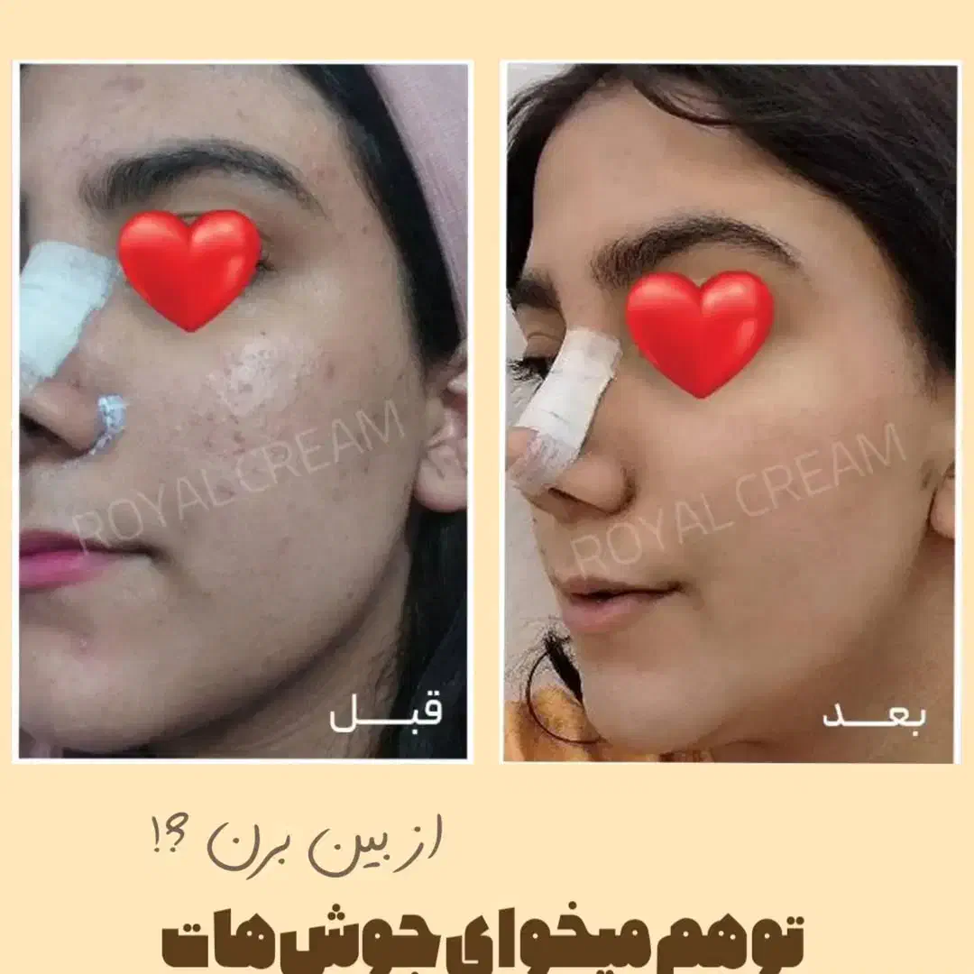 اگه دنبال پوست خوبی پیام بده|آرایشی، بهداشتی، درمانی|خلخال, |دیوار