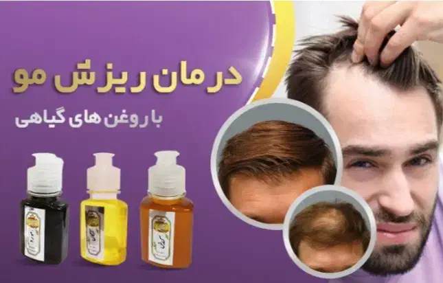 درمان شوره و خارش و ریز ش مو|آرایشی، بهداشتی، درمانی|رودبار (کرمان), |دیوار