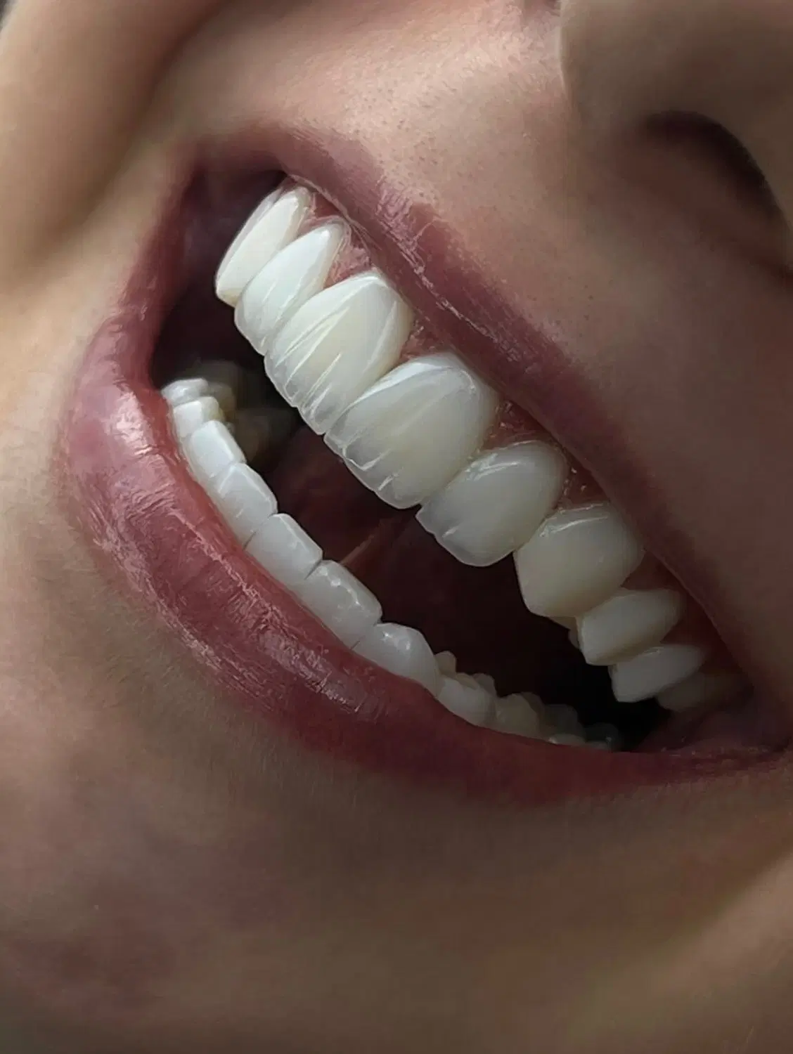 کامپوزیت( اقساط شیش ماهه/از دم قسط)روکش و عصبکشی|خدمات زیبایی و سلامت|تهران, فلسطین (میدان انقلاب)|دیوار