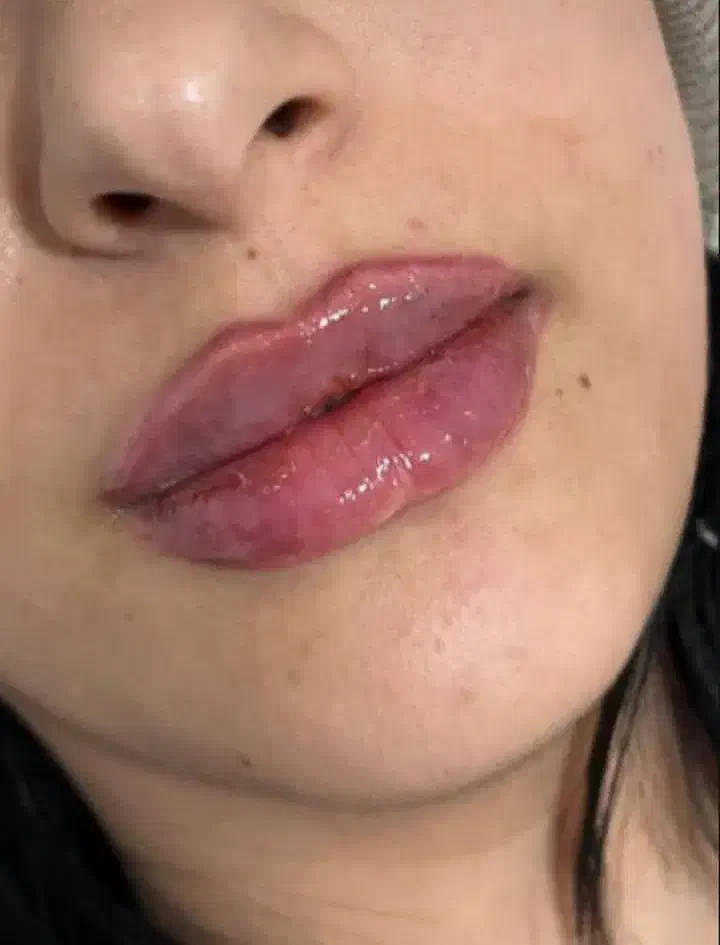 فیلر و بوتاکس|خدمات آرایشگری و زیبایی|بندر دیر, |دیوار