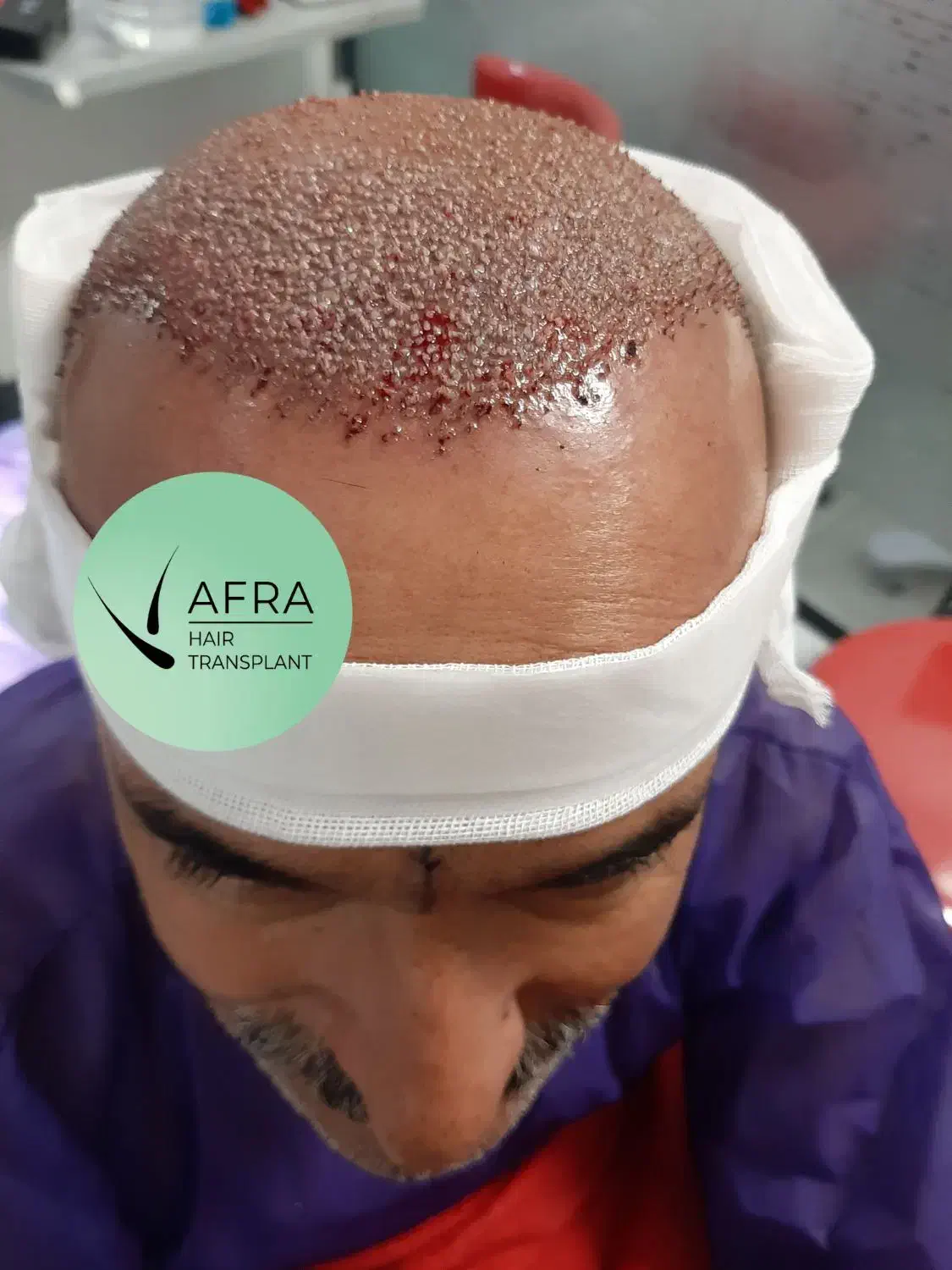 تکنسین کاشت مو هستم|خدمات آرایشگری و زیبایی|تهران, مرزداران|دیوار