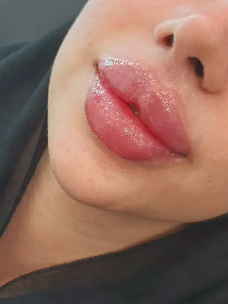 تزریق ژل و بوتاکس|خدمات آرایشگری و زیبایی|کارون, |دیوار