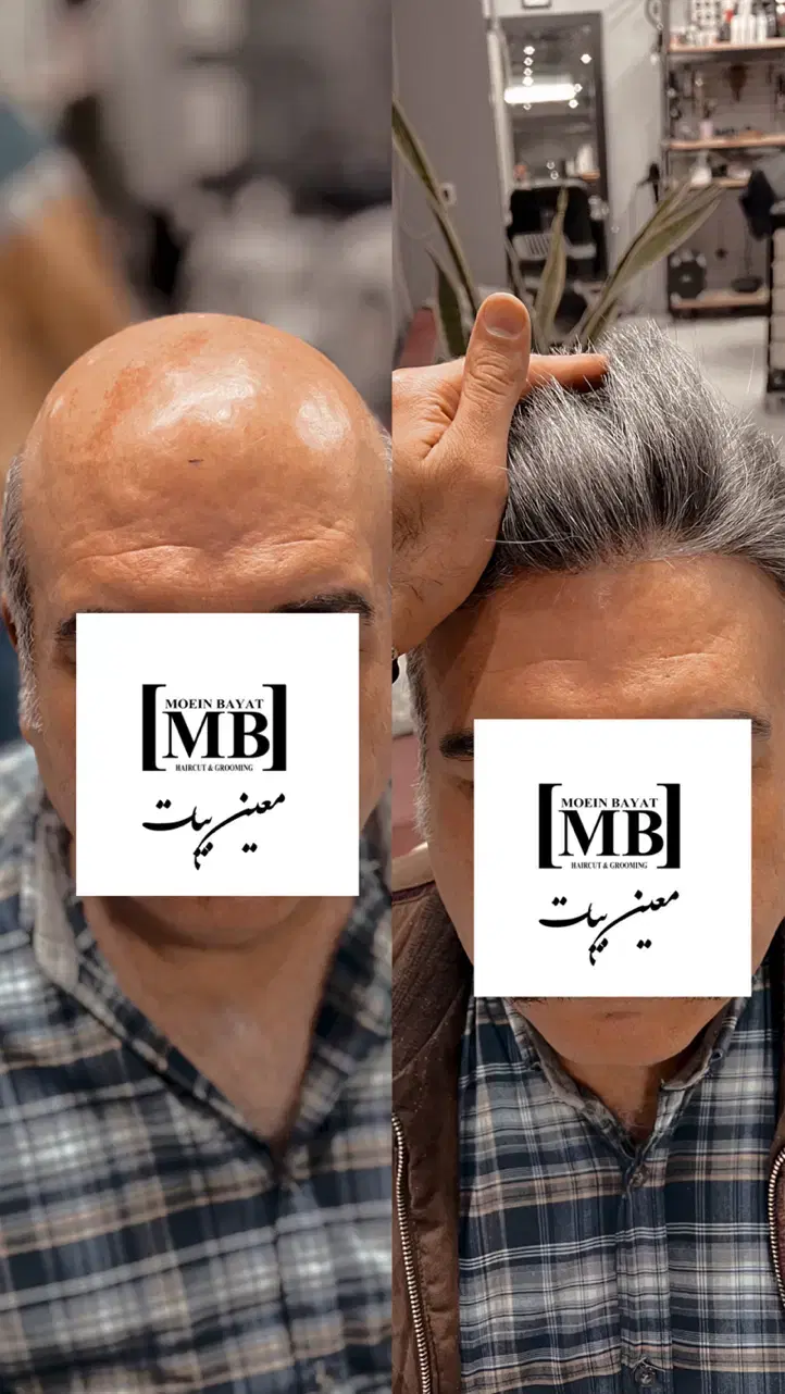 مرکز تخصصی پروتز مو ،جایگزین کاشت مو/همدان|خدمات زیبایی و سلامت|همدان, |دیوار
