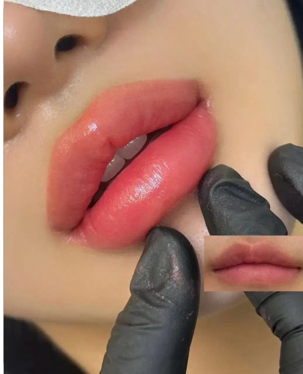 ژل و بوتاکس صورت|خدمات آرایشگری و زیبایی|فولادشهر, مسکن مهر فولادشهر|دیوار