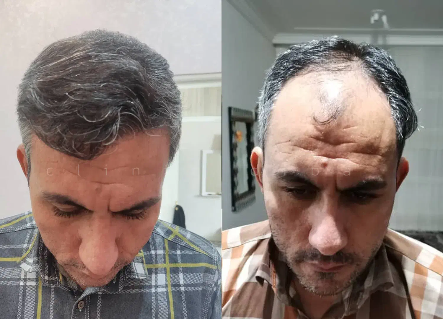 کاشت مو، ابرو، ریش توسط تکنسین15سال تجربه|خدمات آرایشگری و زیبایی|تهران, صادقیه|دیوار