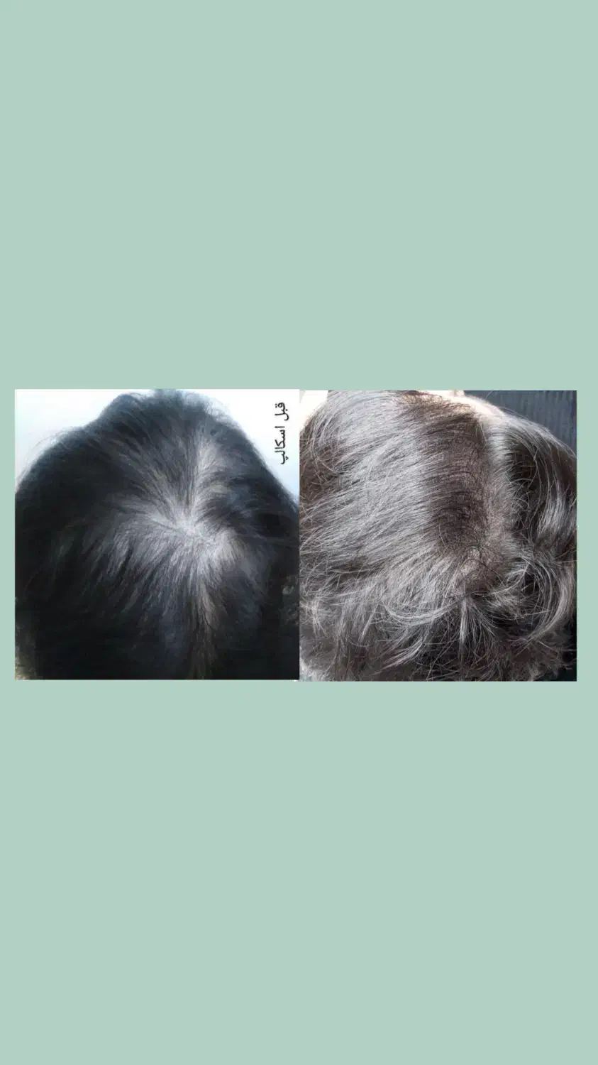 میکرواسکالپ سر|خدمات آرایشگری و زیبایی|گرگان, |دیوار