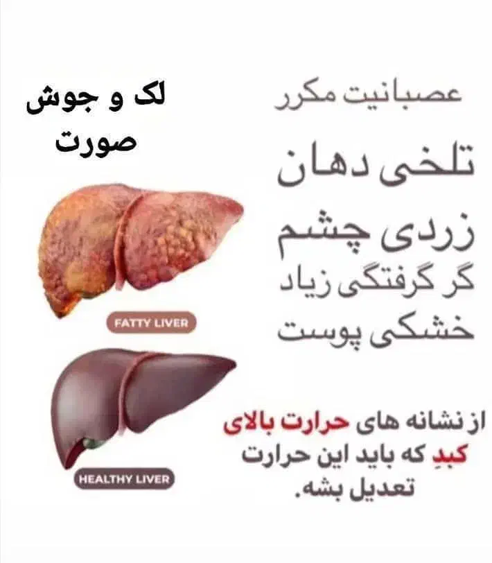 درمان تضمینی کبد چرب|آرایشی، بهداشتی، درمانی|قوچان, |دیوار