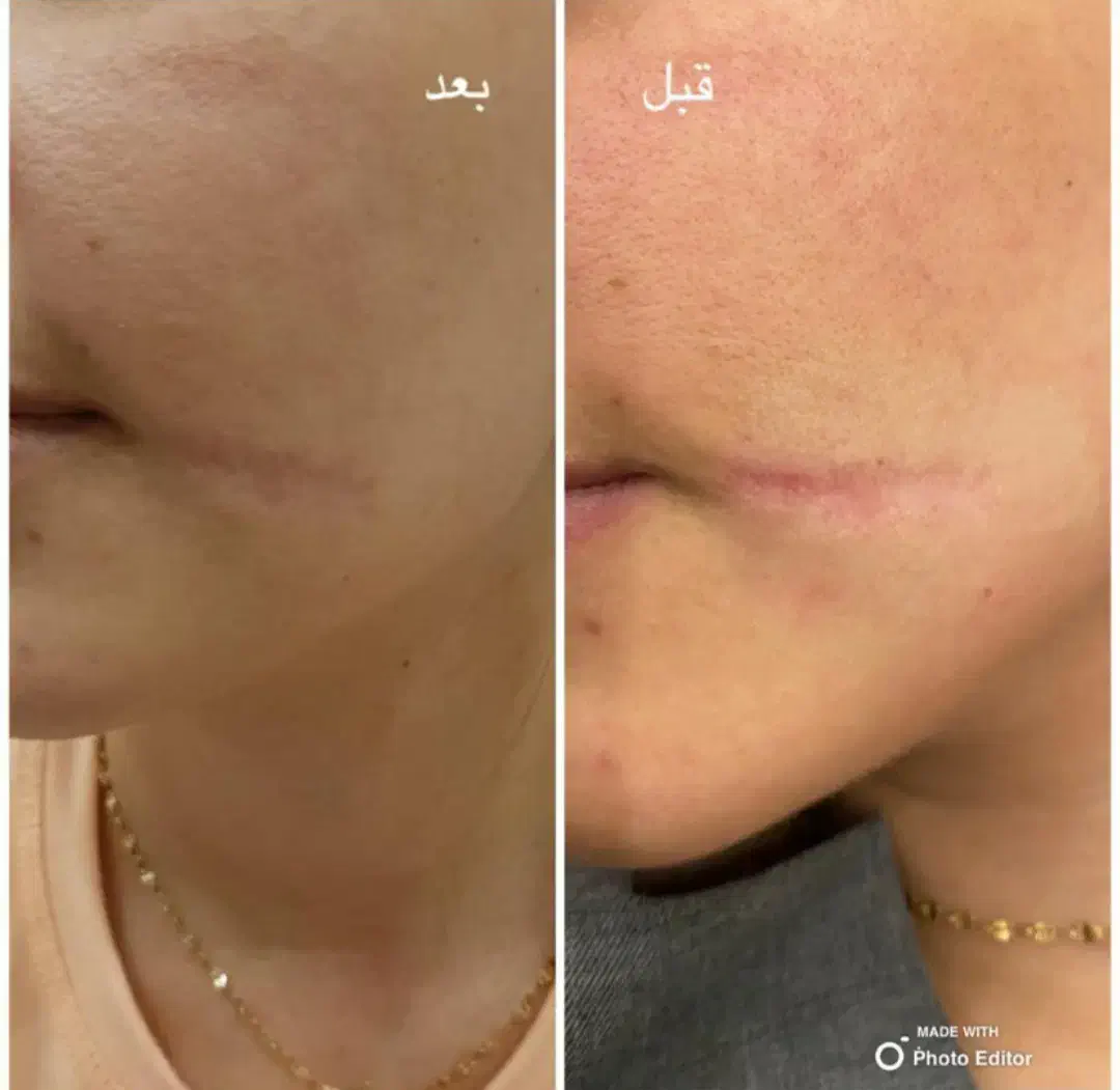 آموزش مزو نیدلینگ +تکنیک پوست کره ای+کاموفلاژ بدن|خدمات آموزشی|مشهد, هنرستان|دیوار