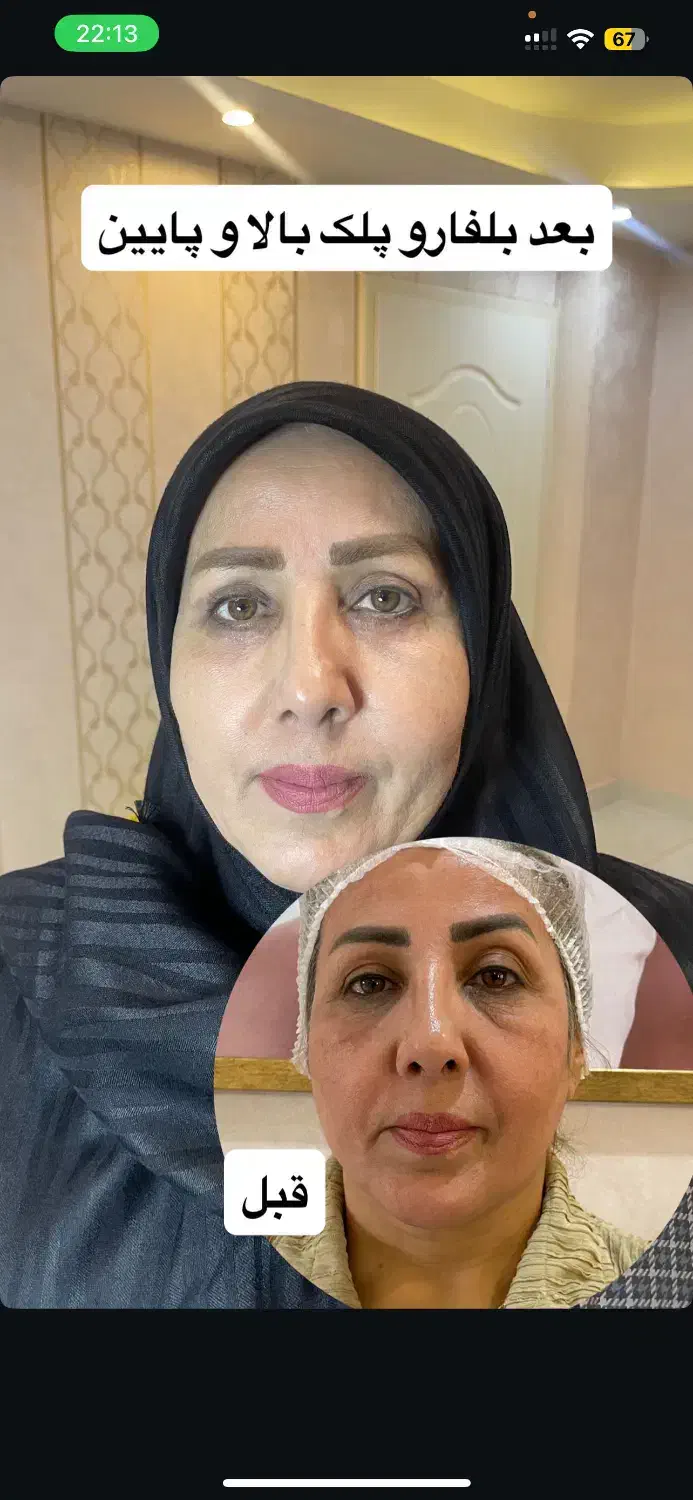 بلفاروپلاستی ، ژل ، بوتاکس|خدمات زیبایی و سلامت|تبریز, |دیوار