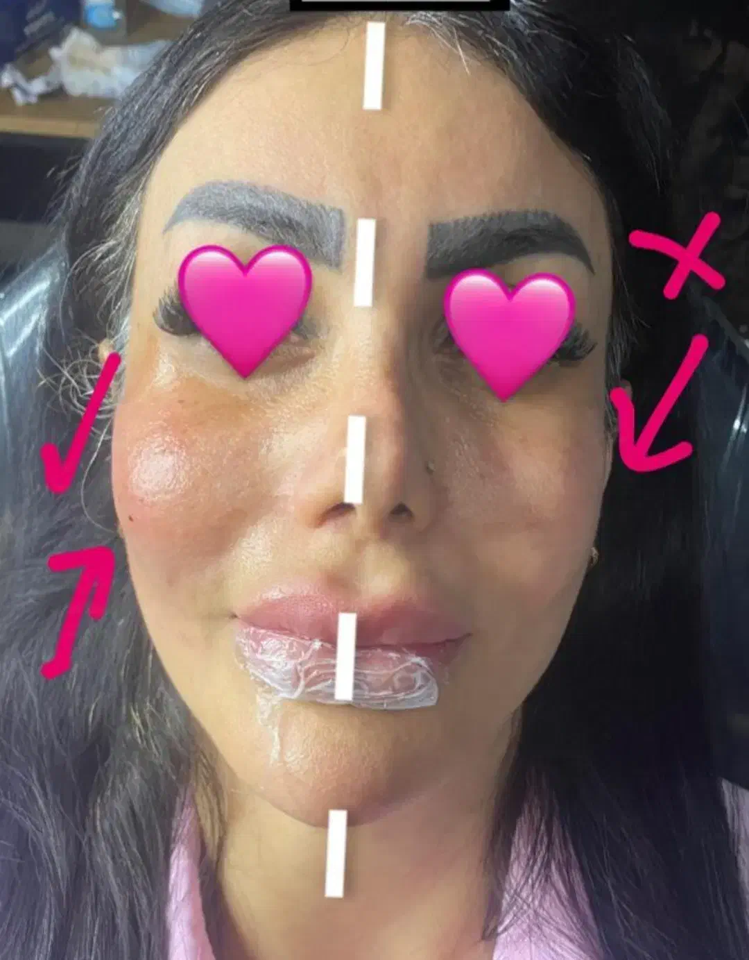 ژل بوتاکس مزو|خدمات آرایشگری و زیبایی|صدرا-فارس, فاز ۱|دیوار