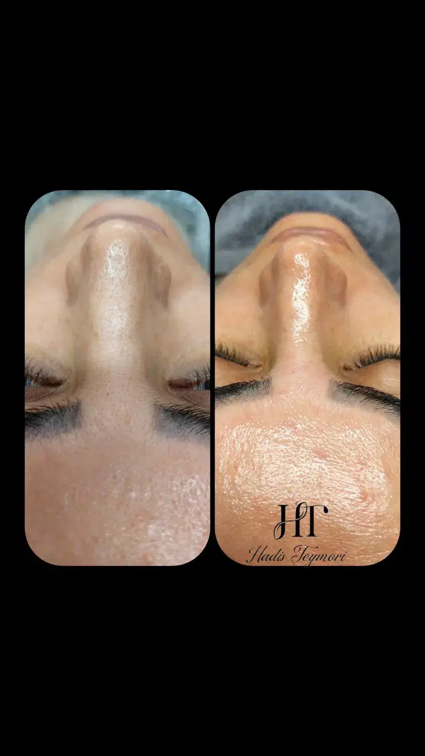 تخفیف ویژه فیشال تخصصی با مواد تانورا تایک هفته|خدمات آرایشگری و زیبایی|مشهد, طرق|دیوار