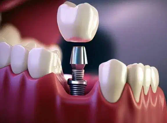 خدمات تخصصی ایمپلنت و اوردنچر|خدمات آرایشگری و زیبایی|اصفهان, کوی ولی عصر|دیوار