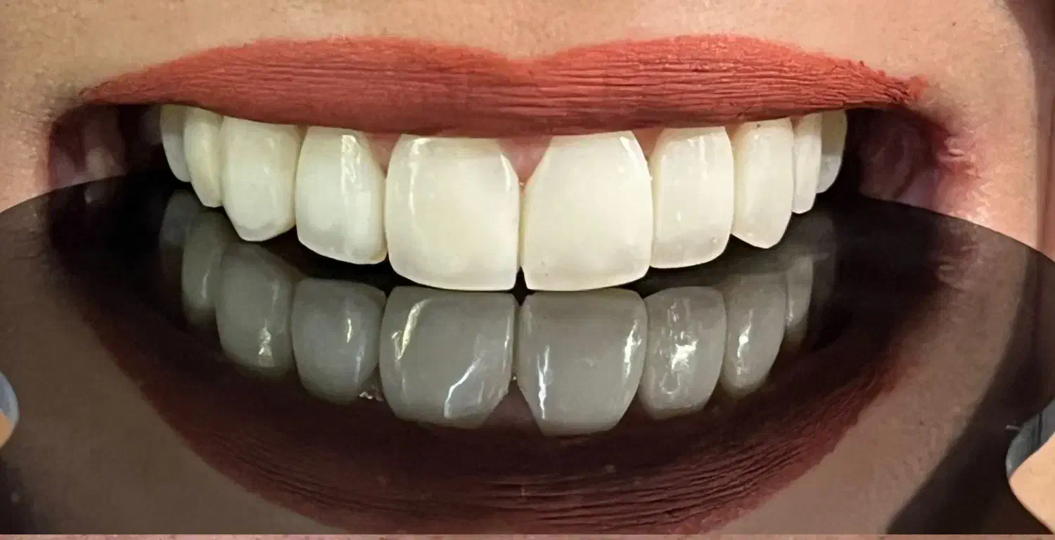 ونیر کامپوزیت ژاپنی اصل (تعرفه دولتی + اقساط)|خدمات آرایشگری و زیبایی|علیآباد کتول, |دیوار