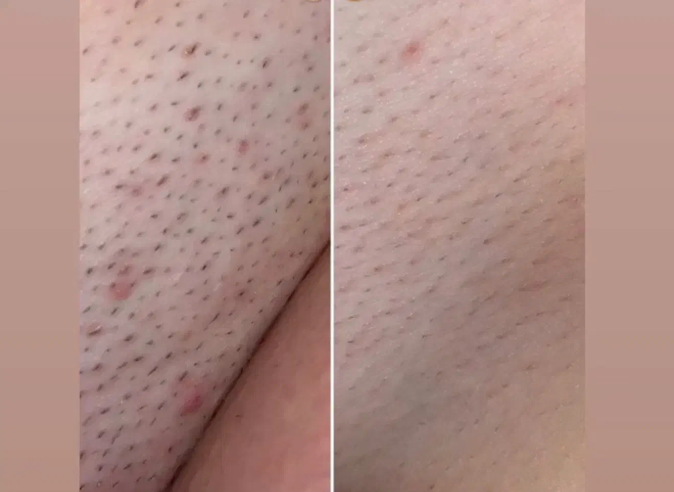 لیزر موهای زائد۳۹۰|خدمات آرایشگری و زیبایی|بابل, |دیوار