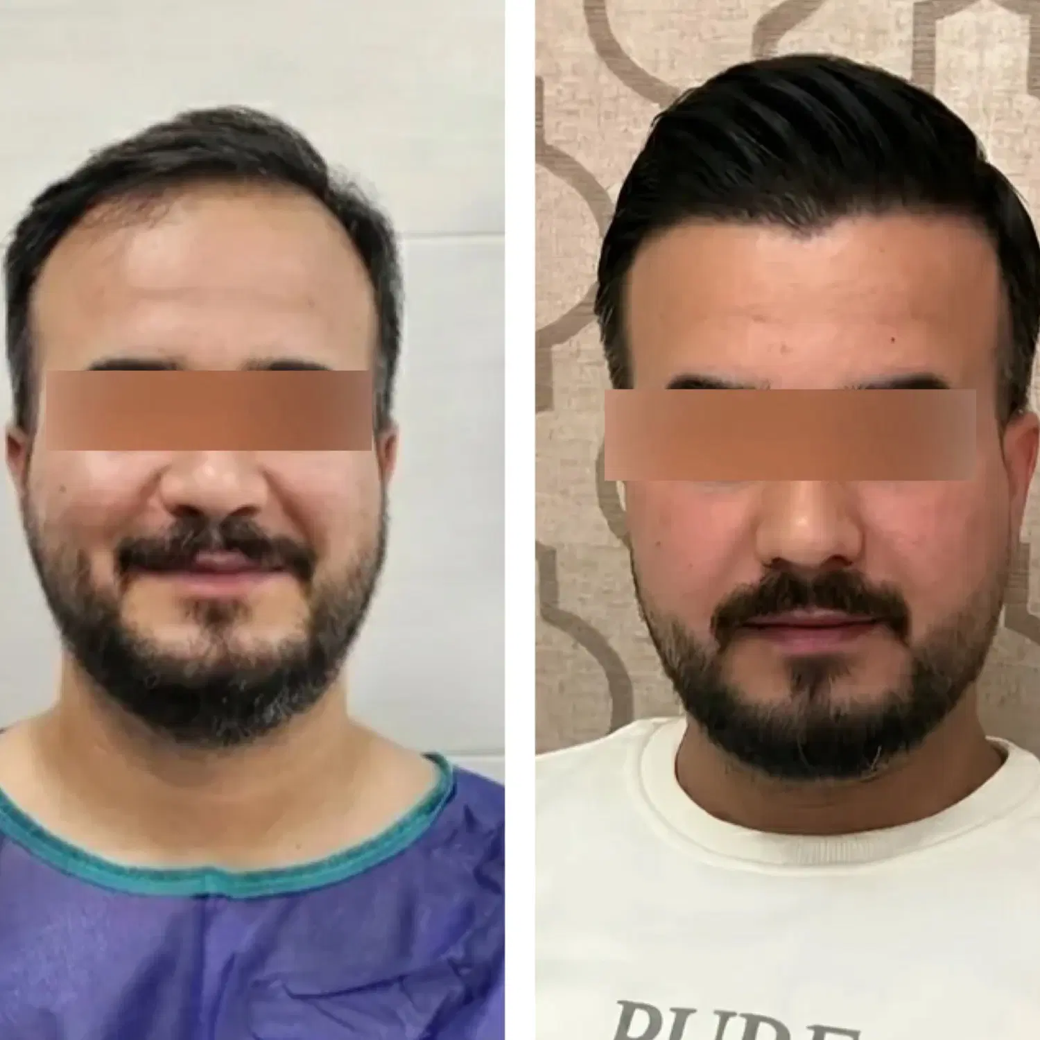 کاشت مو شیرازی vip فول تراکم تعرفه استثنایی|خدمات زیبایی و سلامت|تهران, پاسداران|دیوار