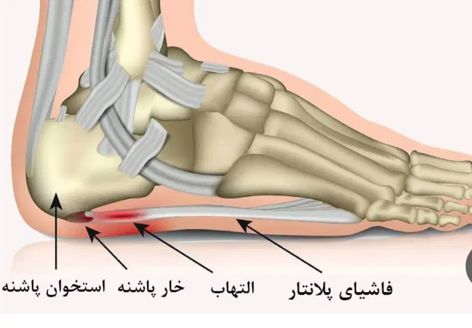 مرکز درمان خارپاشنه و دردپاشنه|خدمات آرایشگری و زیبایی|رزن, |دیوار