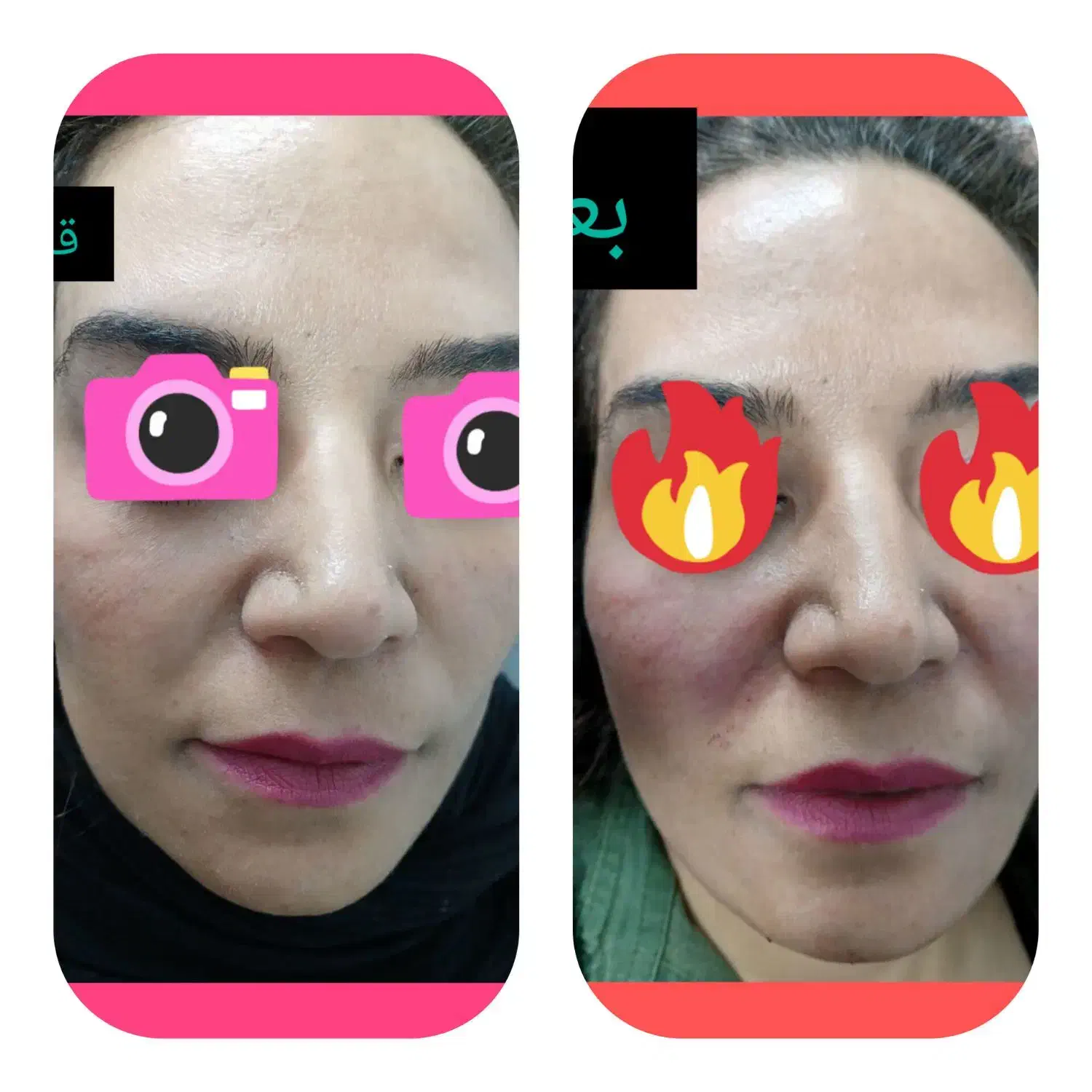 مزو میکرو نیدلینگ ،جوانسازی|خدمات آرایشگری و زیبایی|همدان, |دیوار