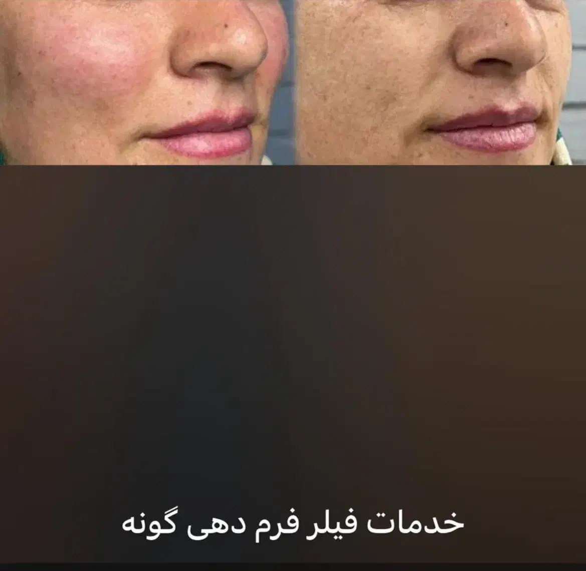 ژل/بوتاکس /فیلر بادی /|خدمات آرایشگری و زیبایی|شیراز, ستارخان|دیوار