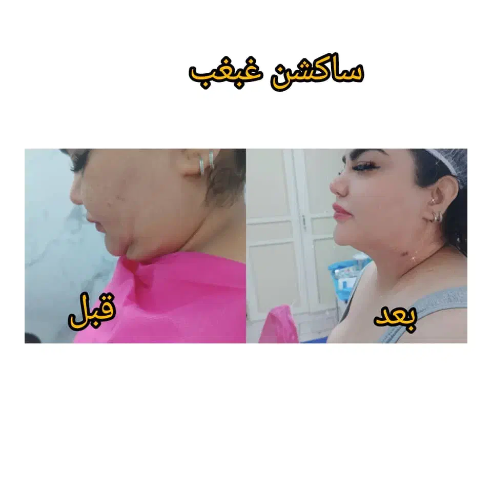 ساکشن چربی بلفاروپلاستی ژل بوتاکس لابیاپلاستی|خدمات آرایشگری و زیبایی|بوشهر, |دیوار