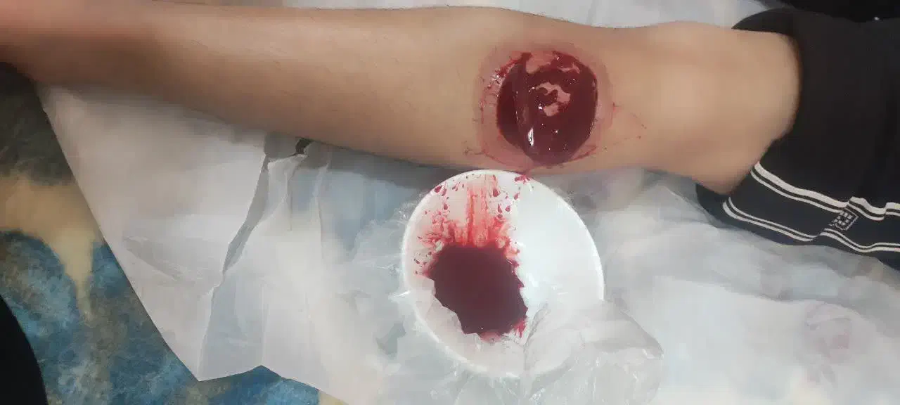 طب سوزنی،زالو درمانی،حجامت|خدمات آرایشگری و زیبایی|تربت جام, شهید نصرالهی|دیوار