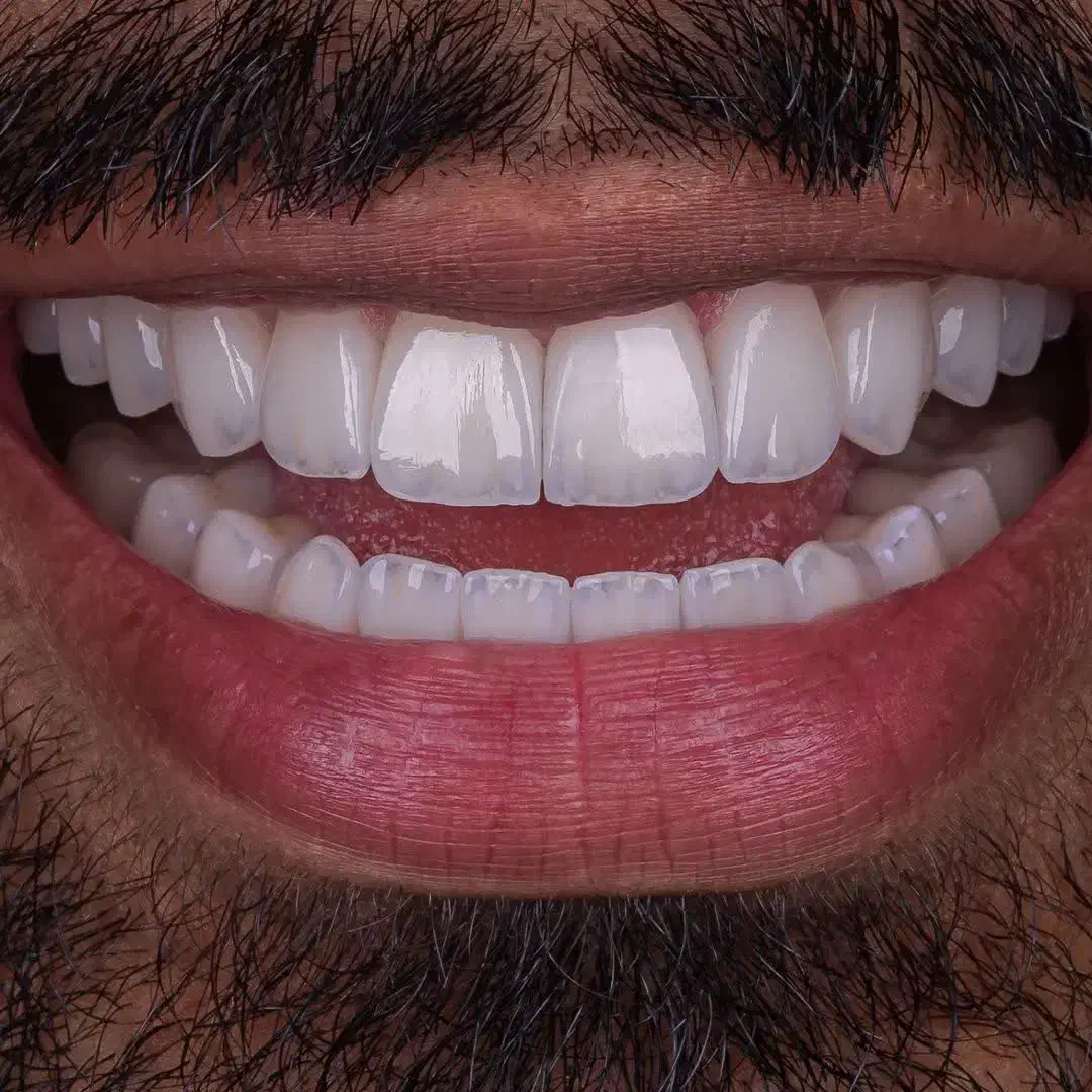 کامپوزیت/لمینیت/ایمپلنت/عصب کشی،و درمانی اقساطی|خدمات آرایشگری و زیبایی|مشهد, جنت|دیوار