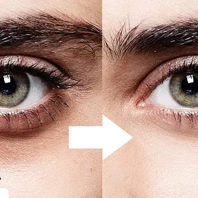 درمان سیاهی زیر چشم|خدمات آرایشگری و زیبایی|کاشان, بهشتی|دیوار