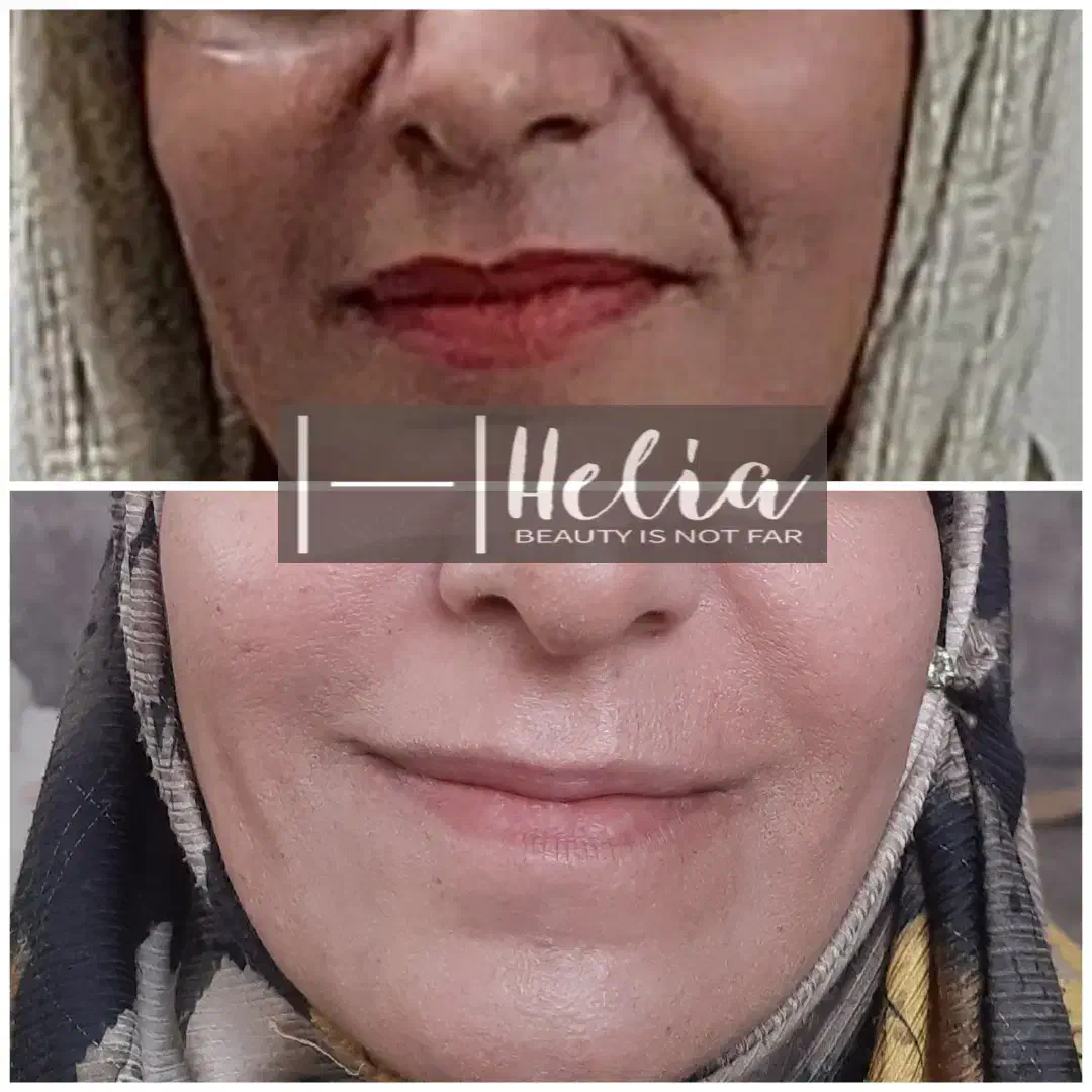 تزریق تخصصی فیلر|خدمات آرایشگری و زیبایی|شیراز, تندگویان|دیوار