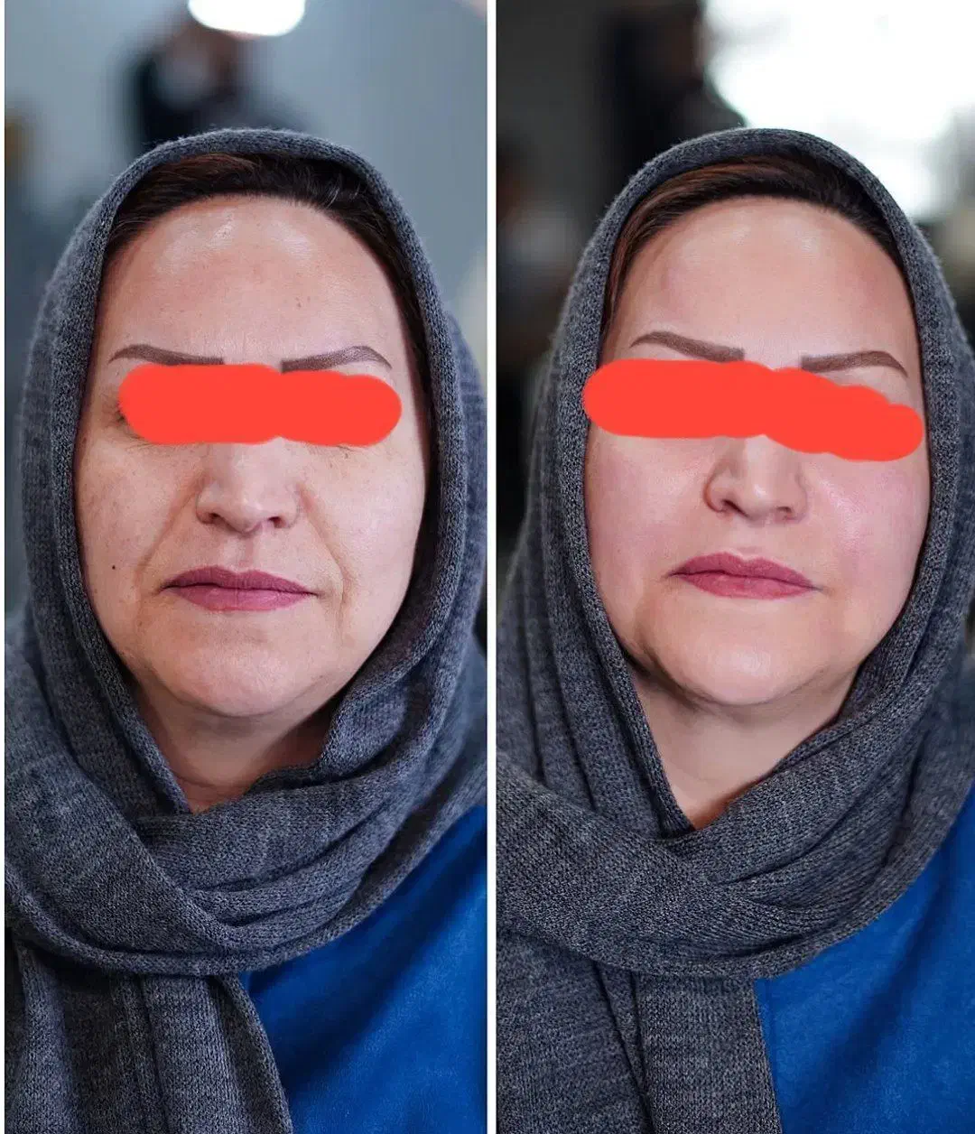 کرم 5 کاره|آرایشی، بهداشتی، درمانی|شیراز, میانرود|دیوار