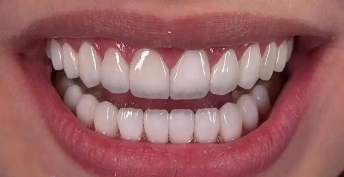 کامپوزیت دندان|خدمات آرایشگری و زیبایی|پرند, فاز ۱|دیوار