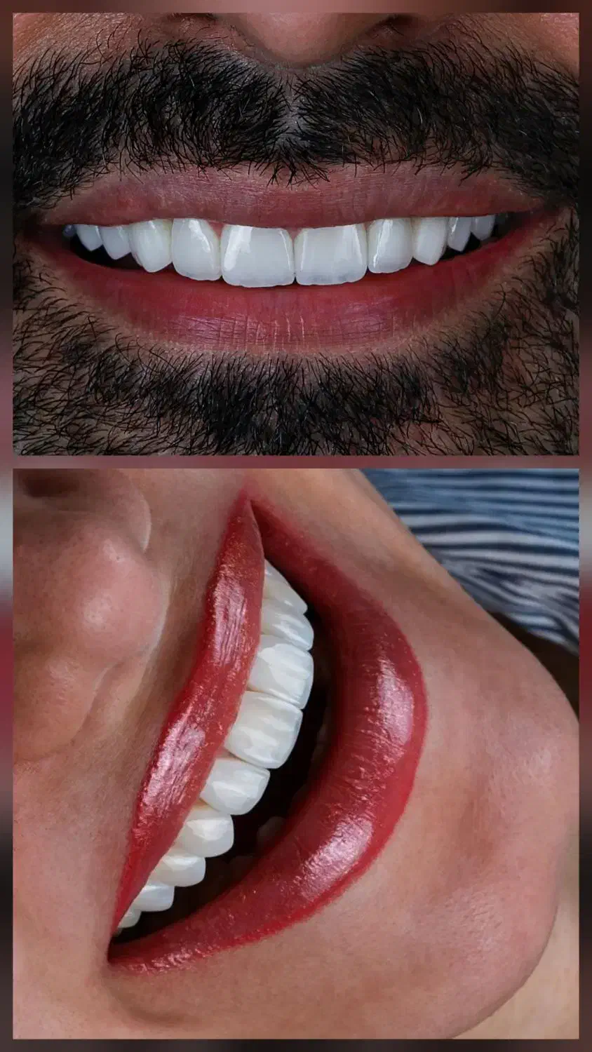 دندانپزشکی/ کامپوزیت زیبایی/ لمینت/دندان مصنوعی|خدمات آرایشگری و زیبایی|تهران, نعمت‌آباد|دیوار