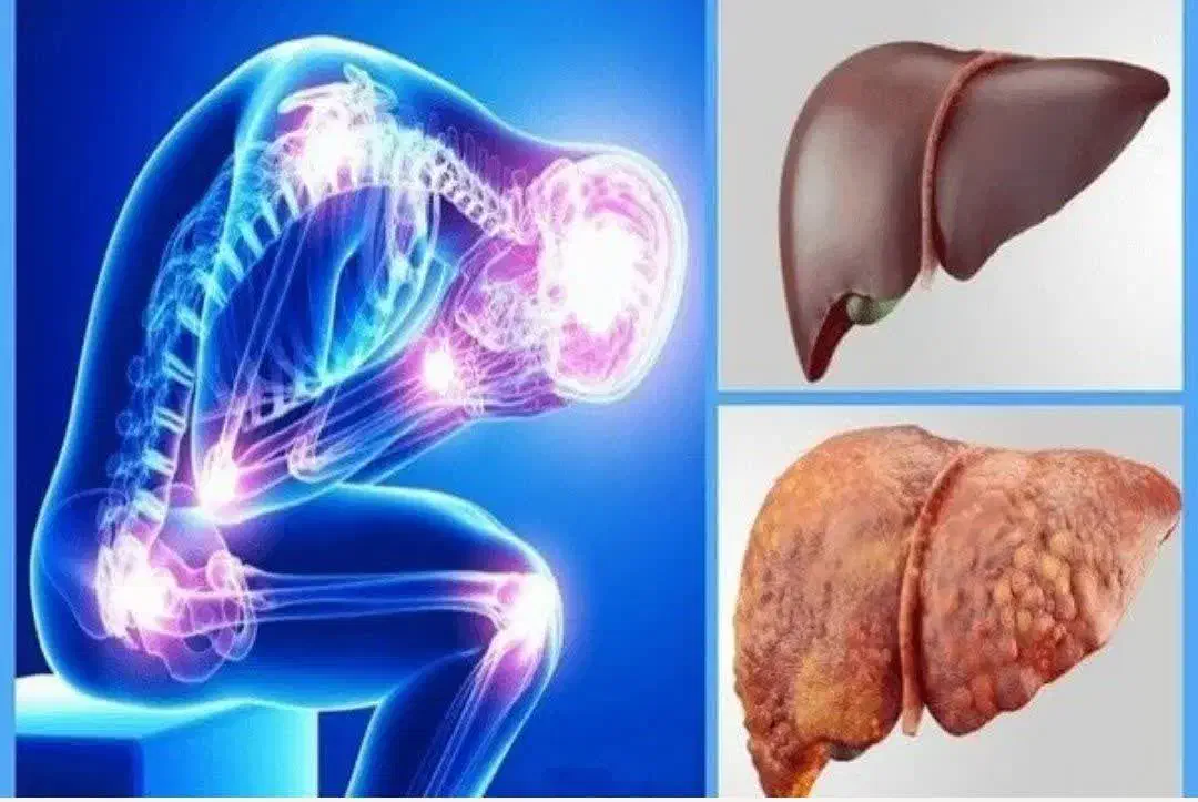 درمان کبد چرب|آرایشی، بهداشتی، درمانی|شیراز, بعثت|دیوار