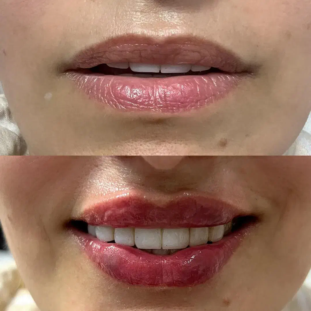 تزریق ژل چربی بوتاکس جوان ساز مزو پی آرپی|خدمات آرایشگری و زیبایی|رشت, گلسار|دیوار