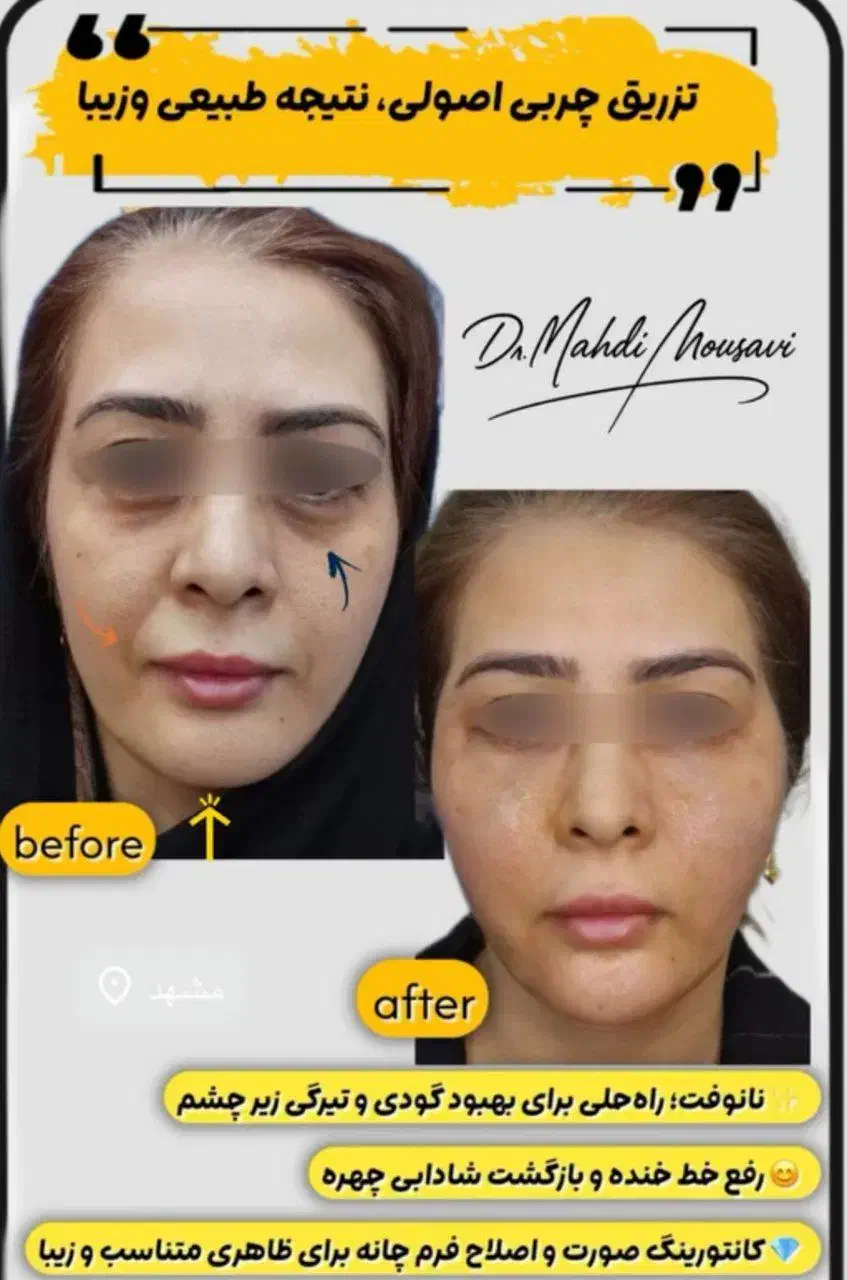 مرکز تخصصی تزریق فول فیس چربی و فیلر/لیفت با نخ|خدمات آرایشگری و زیبایی|مشهد, هنرستان|دیوار