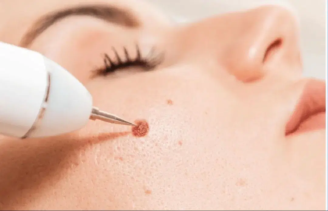 پلاسما . فشیال پاییزه 25%|خدمات زیبایی و سلامت|اصفهان, مهرآباد|دیوار
