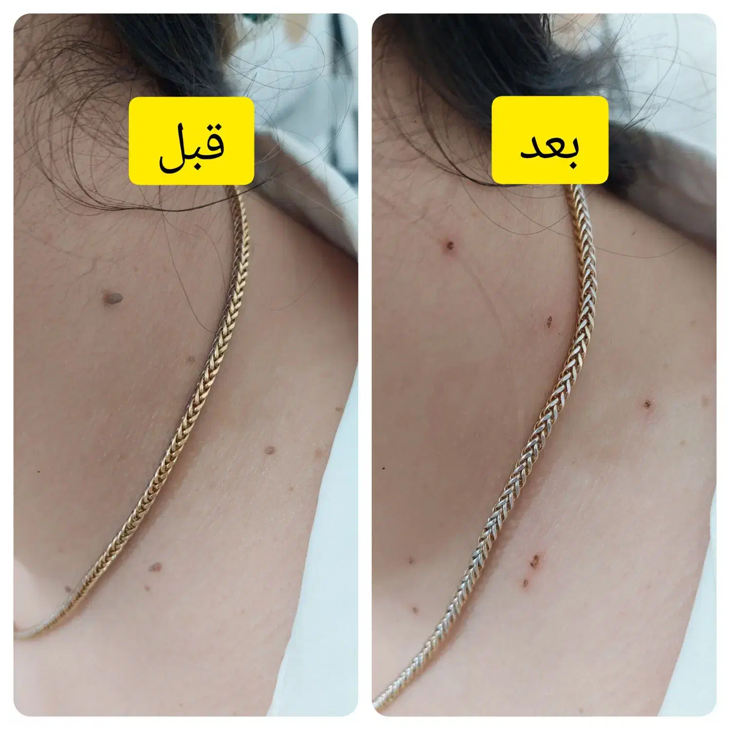 برداشتن خال و انواع ضایعه پوستی|خدمات آرایشگری و زیبایی|گرگان, |دیوار