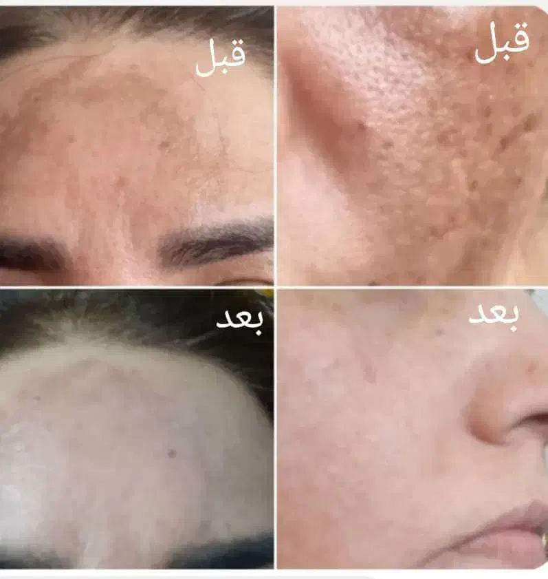 کرم تضمینی جواب نگرفتی پولتوپس بگیر|آرایشی، بهداشتی، درمانی|سراوان, |دیوار