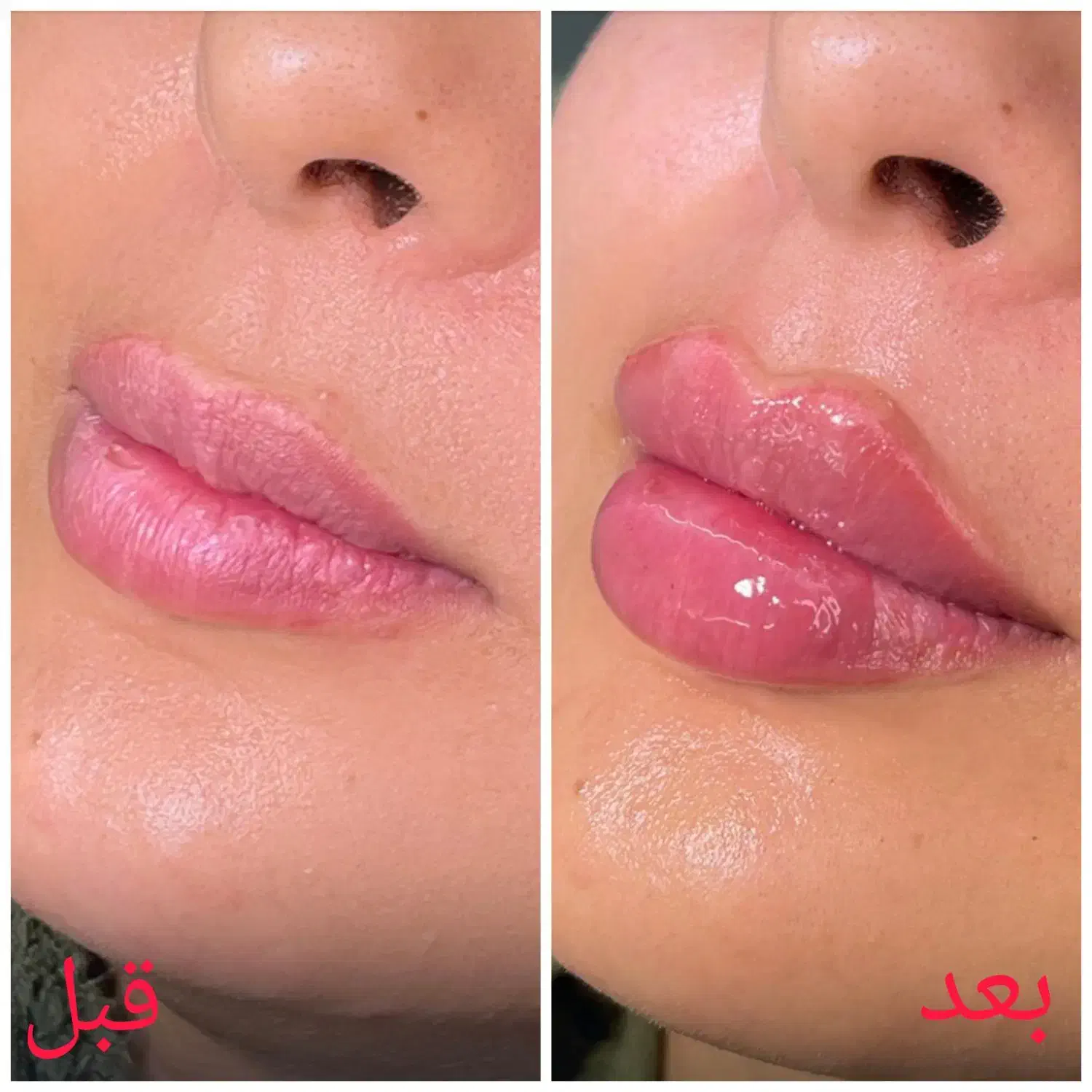 تخفیف به مناسبت روز مادر /ژل لب- کانتورینگ- بوتاکس|خدمات آرایشگری و زیبایی|مشهد, ایثار|دیوار